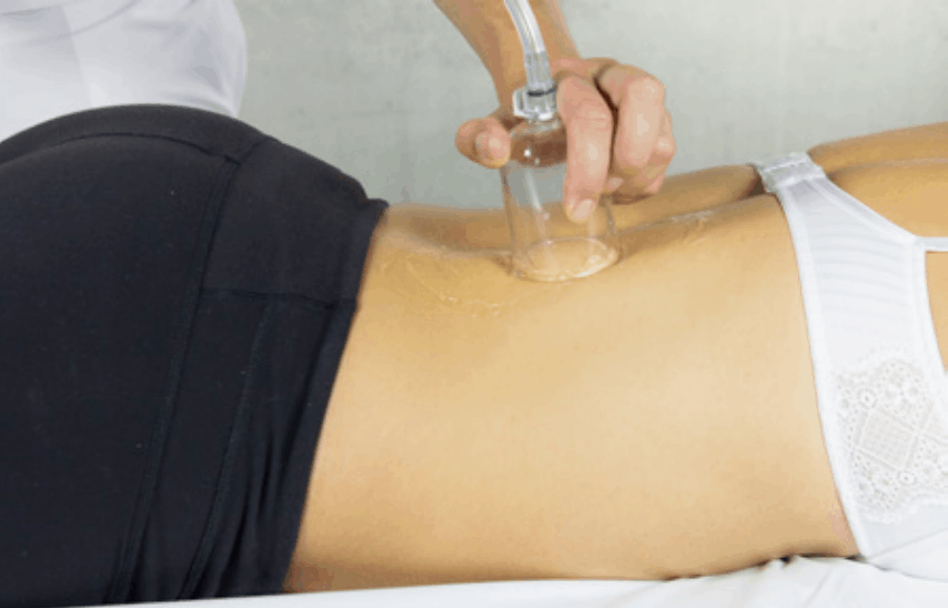 Storz VACU-ACTOR® Shockwave Cupping
