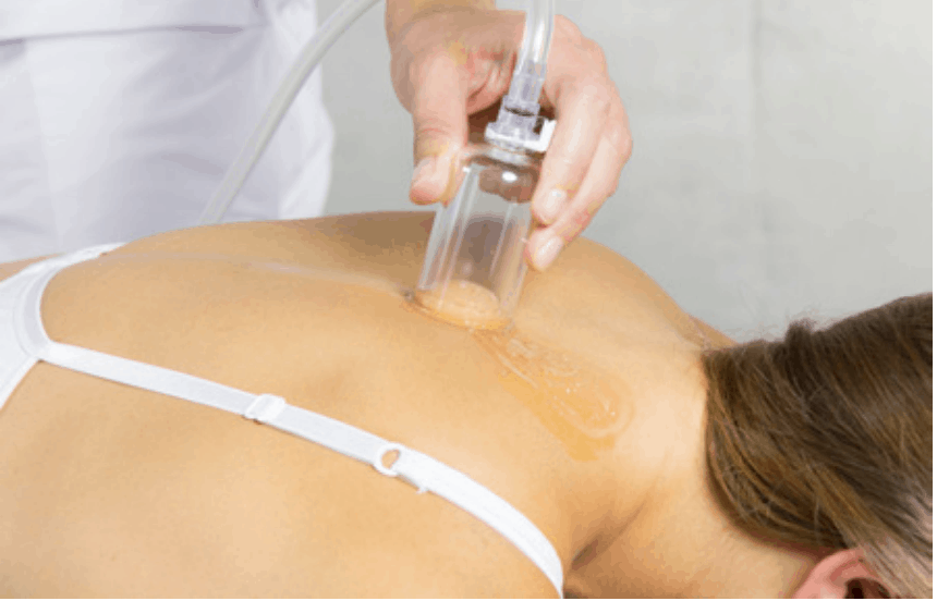 Storz VACU-ACTOR® Shockwave Cupping