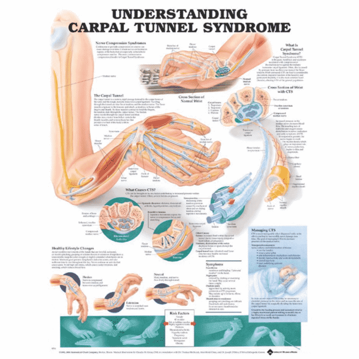 Understanding Carpal Tunnel Wall Chart