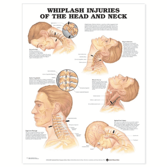 Whiplash Injuries of Head/Neck Call Chart