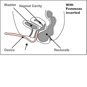 Femmeze® Vaginal Trainer for Rectocele
