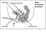 Femmeze® Vaginal Trainer for Rectocele